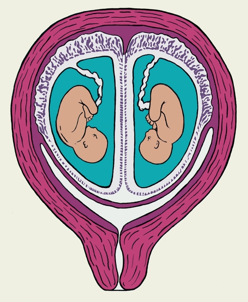 Схематическое изображение плодов (показано на разрезе), развивающихся в матке из двух яйцеклеток, имплантировавшихся близко друг к другу (двуяйцовая двойня)